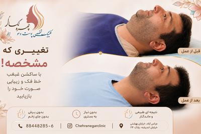 ساکشن غبغب و لیپو غبغب  فقط ۱۴/۹۰۰ با امکان پرداخت شرایط  اقساط ویژه در تهران