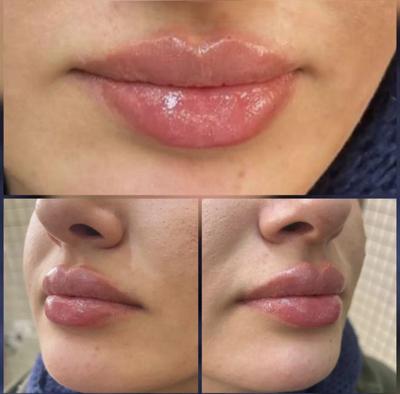 جشنواره ویژه تزریق ژل و مزو و پی آرپی درمطب در اصفهان