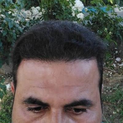 کاشت تخصصی موی طبیعی شیراز در شیراز
