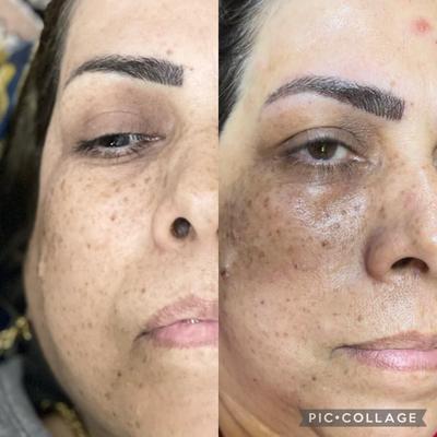 فیشیال و پاکسازی عمقی پوست با تخفیف ویژه در تهران