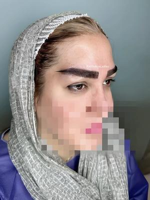 کاشت ابرو متدفاین برو در شیراز