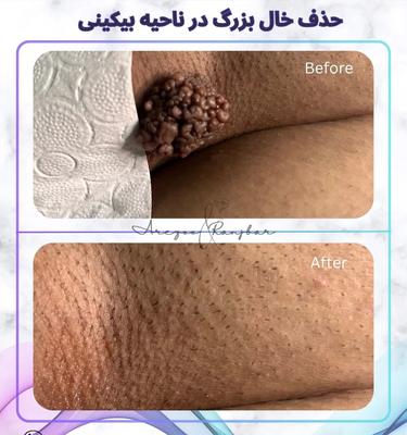 مشاوره رایگان **زگیل تناسلی آقایان و بانوان** در اصفهان