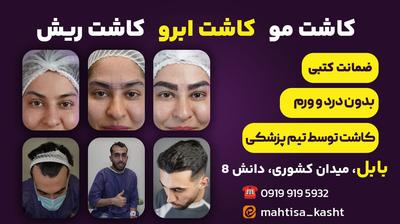 بهترین تیم کاشت مو به بابل آمد در ساری