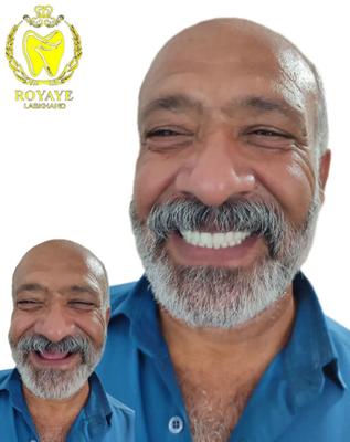 دست دندان کامل (فول دنچر) در بندر عباس