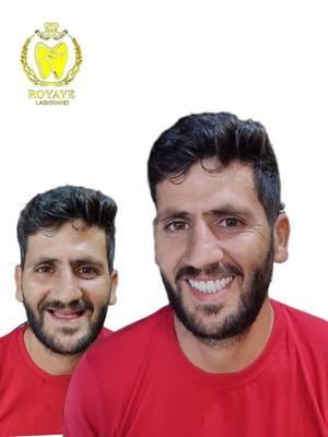 دست دندان کامل (فول دنچر) در بندر عباس