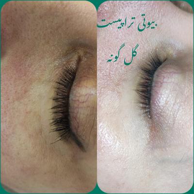 پاکسازی پوست در اراک