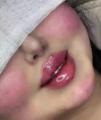 تزریق ژل فیلرلب.بوتاکس مزوژل فیلربادی باتخیفات 50٪ در زاهدان