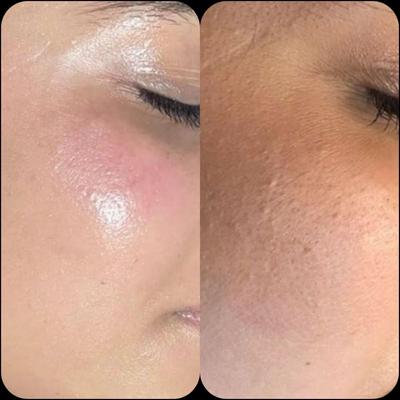 کوکتل تراپی برای مشکلات پوستی و رفع تیرگی بدن در اراک