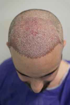 کاشت موی پر تراکم به روش FIT در اصفهان