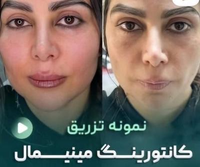 جشنواره ژل و بوتاکس در مطب تخصصی پوست و مو در قم