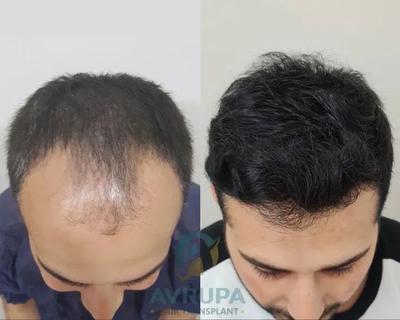 کاشت مو همراه با مزوتراپی رایگان در شیراز