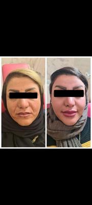 تزریق ژل وفیلر لب و گونه وچانه ومزو(جشنواره)درمطب در اصفهان