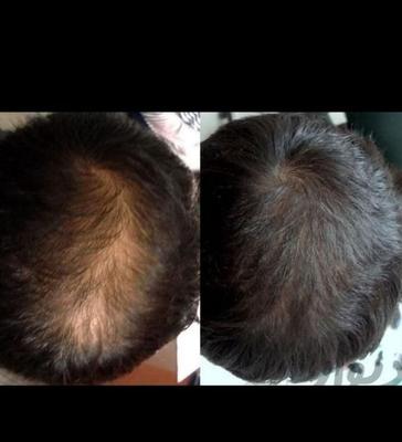 تزریق پی ار پی،PRP،ترمیم تخصصی زخم ها،ازون درمانی در قم