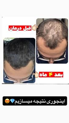 پک اگزونیک ، قطع ریزش مو و رویش مجدد مو در کرج