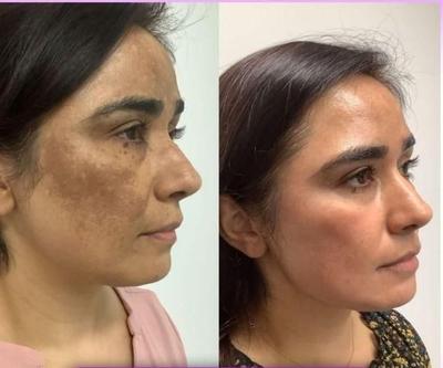 لیزر co2ترکیبی تک جلسه ای در یاسوج