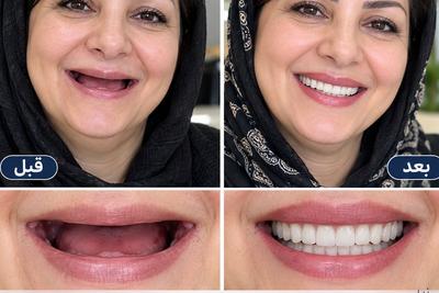 دندان مصنوعی تحویل فوری یک روزه ارزان یا دندانسازی باکیفیت عالی اقساط در تهران