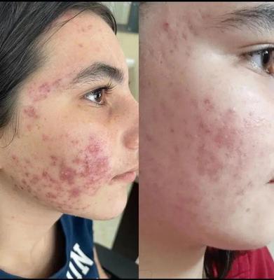 پاکسازی کبد چرب در گنبد کاووس