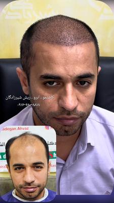 کاشت مو تخصصی شیرزادگان در اهواز