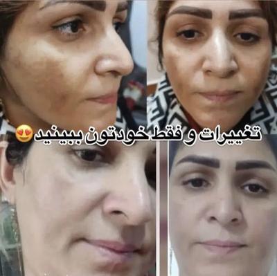 کرم بدن صورت ضدلک سفیدکننده تضمینی بی بازگشت در تهران