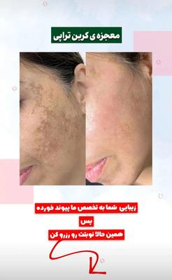 حذف تتو و روشن سازی نواحی تیره بدن با لیزر در گرگان