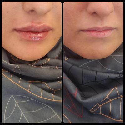 تخفیف ویژه انواع خدمات ژل /بوتاکس/جوانسازی در قم