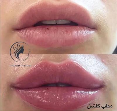 جشنواره ویژه تزریق ژل و بوتاکس و مزو پی آرپی درمطب در اصفهان
