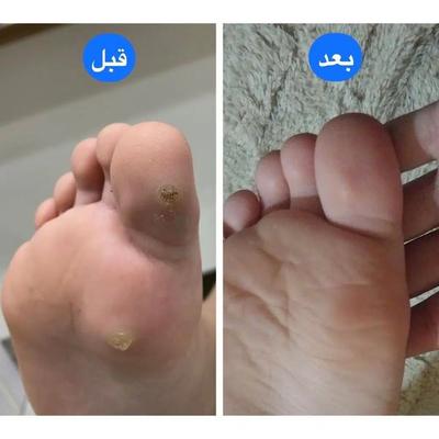 بهبودی زگیل تناسلی بدونه نیاز به فریز در گرگان