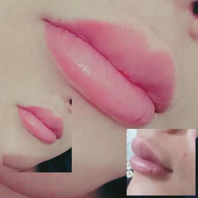 ژل و بوتاکس در کلینیک زیبایی در خرم‌آباد