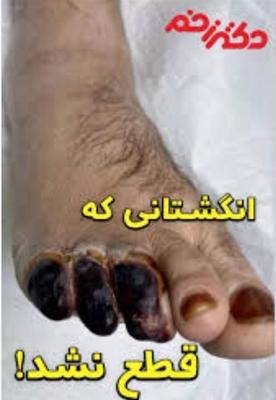 بهبودی دیابت بدونه نیاز به قرص در گرگان
