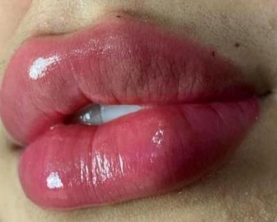 خدمات ژل وبوتاکس ورنگ در اهواز