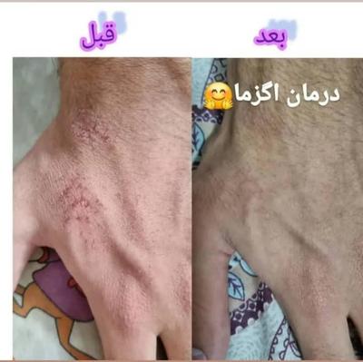 لک صورت در بروجرد