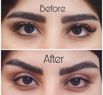 بلفارو،دایرکت ابرو،میدفیس،ساکشن اقساطی در کرج