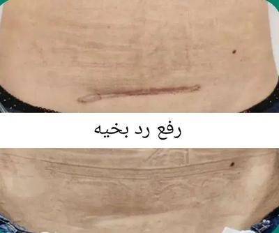 لیزر و رفع رد بخیه و اسکار در مشهد