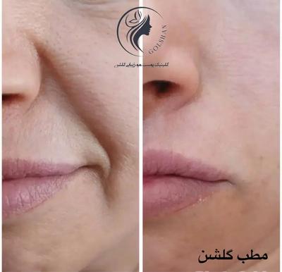 جشنواره ویژه تزریق ژل و بوتاکس و مزو پی آرپی درمطب در اصفهان