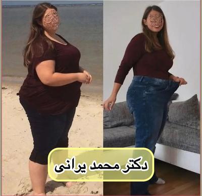 بهترین دکتر لاغری اسلیو معده تهران در تهران