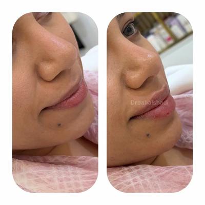 تزریقات نانوکلاژن،ژل،بوتاکس تخصصی دکتر شادی بابایی در بندر عباس