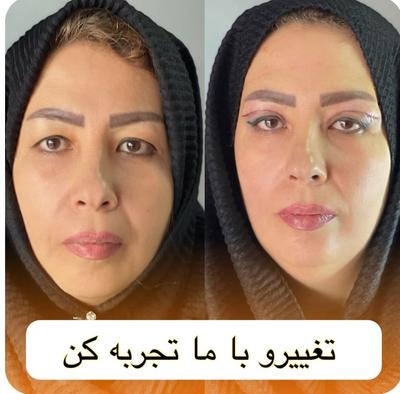 بلفاروپلاستی(جراحی پلک) در تهران
