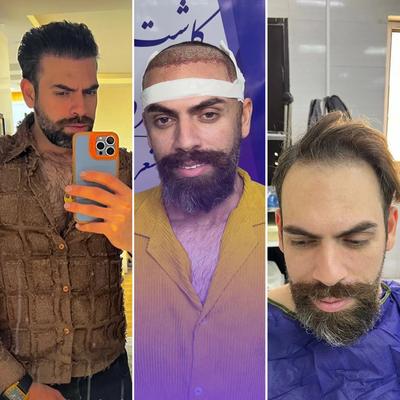 کاشت مو ابرو مزو و پی آر پی بوتاکس در اهواز