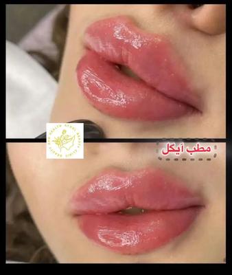تزریق ژل وفیلر لب و گونه وچانه ومزو(جشنواره)درمطب در اصفهان