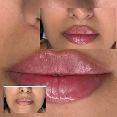 ژل و بوتاکس در کلینیک زیبایی در خرم‌آباد