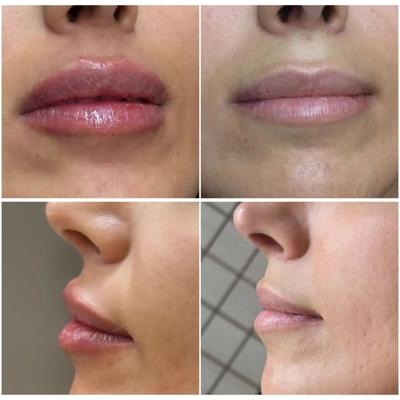 جشنواره ویژه تزریق ژل و مزو و پی آرپی درمطب در اصفهان