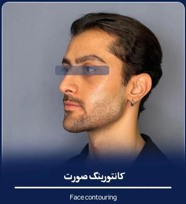 فیلر بادی ژل لب بوتاکس لیفت بلفاروپلاسی بوکال فت در اصفهان