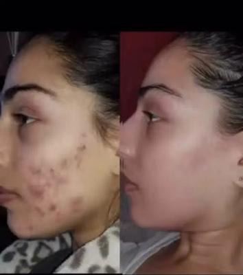 کرم سفیدکننده ضدلک دائمی جوانسازجوش منافذصورت بدن در تهران