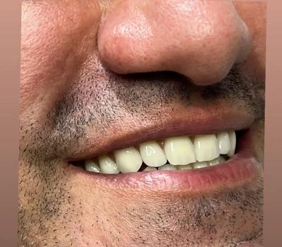 اوردنچر (دندان مصنوعی متکی بر ایمپِلنت) در یزد