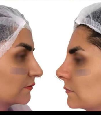 بوتاکس ژل لیفت نخ صورت بینی بلفاروپلاستی فیلر چرب در اصفهان