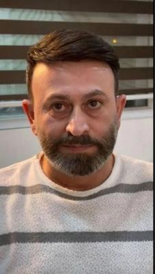 پروتز مو در ایلام