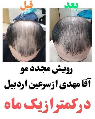 رویش مجدد مو و قطع ریزش مو در بجنورد