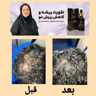 رفع قطعی ریزش مو و رویش مجدد در بجنورد