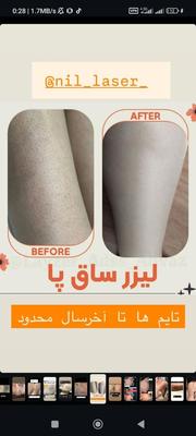 مرکز لیزر موج کندلا زائد لیزر بانوان لیزر آقایان در اصفهان