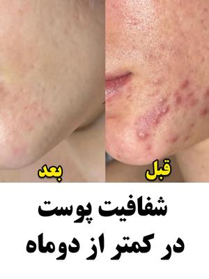 سرم مغذی لاکچری، رفع لک، رفع چروک و جوانسازی در کرج